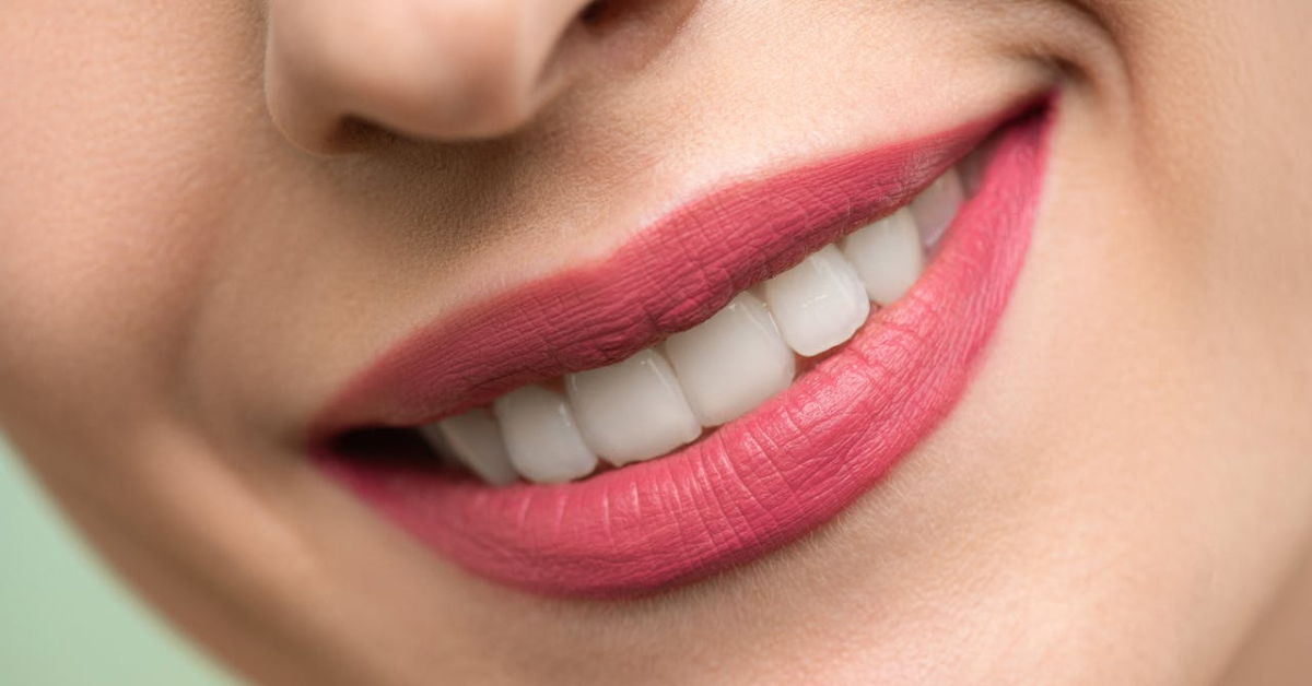 Benefits of Laser Teeth Whitening in Sugar Land
